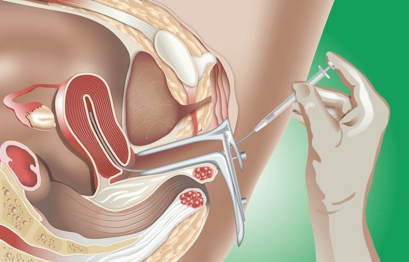 GIÃN TĨNH MẠCH TINH – NGUY CƠ HIẾM MUỘN