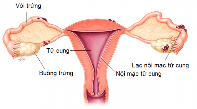 LẠC NỘI MẠC TỬ CUNG       CÓ NGUY HIỂM KHÔNG?