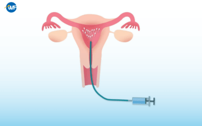 Chuyển phôi bao lâu thì xét nghiệm Beta HCG để có kết quả chính xác nhất?