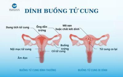 BỆNH QUAI BỊ VÀ MỐI TƯƠNG QUAN VÔ SINH Ở NAM GIỚI