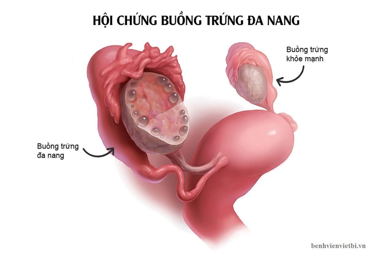 VÔ SINH NAM
