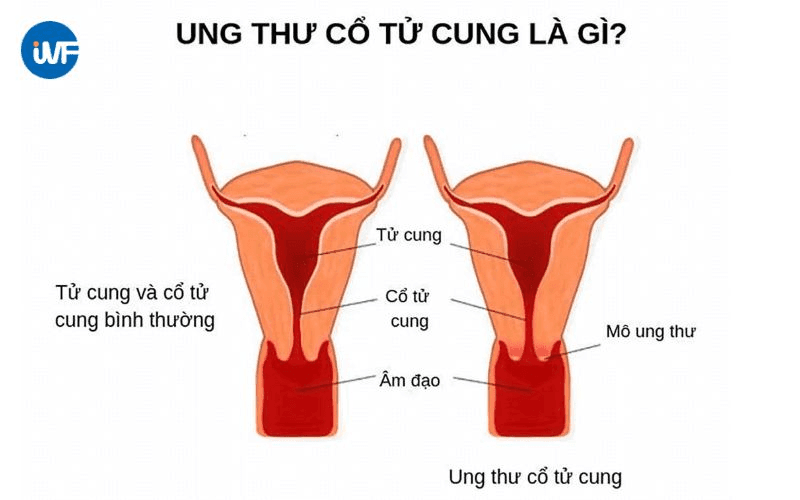 Mô phỏng hình ảnh ung thư cổ tử cung