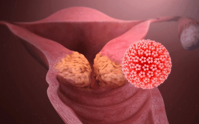 Nguyên nhân chủ yếu là từ virus HPV